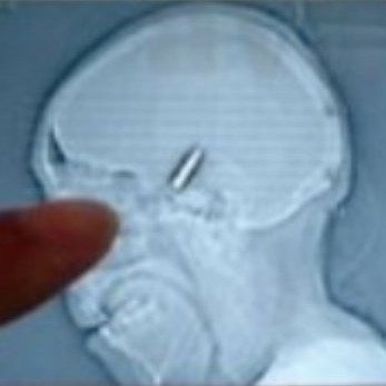 Вратар от аматьорската лига в Босна игра 90 минути с куршум в главата