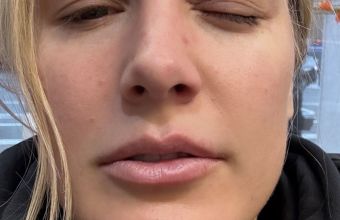 Бушар нарани окото си по време на тренировка. 