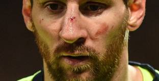 Валверде: Меси е с хематом